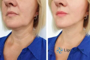 Double chin before and after Hi-Fu treatment 4 Book your double chin treatment Wraysbury today! We are here to help!