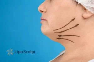 Double chin before and after Hi-Fu treatment 3 Boost your confidence with a Double chin treatment Wraysbury