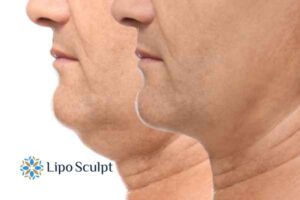 Double chin before and after Hi-Fu treatment 2 Double chin treatment Wraysbury from Lipo Sculpt - feel more confident today!