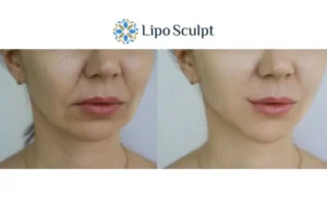 Explaining Total Skin Tightening Treatment And What It Can Do For You 2 Do you want to boost your self confidence? Give Morpheus8 Wraysbury a try today!