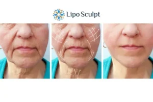 Explaining Total Skin Tightening Treatment And What It Can Do For You 3 Boost your confidence with Morpheus8 Wraysbury call our team today!