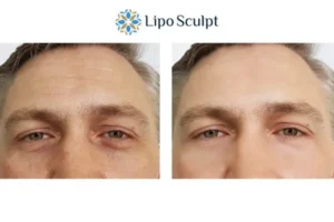 Explaining Total Skin Tightening Treatment And What It Can Do For You 6 Morpheus8 Wraysbury book in today to find out more!