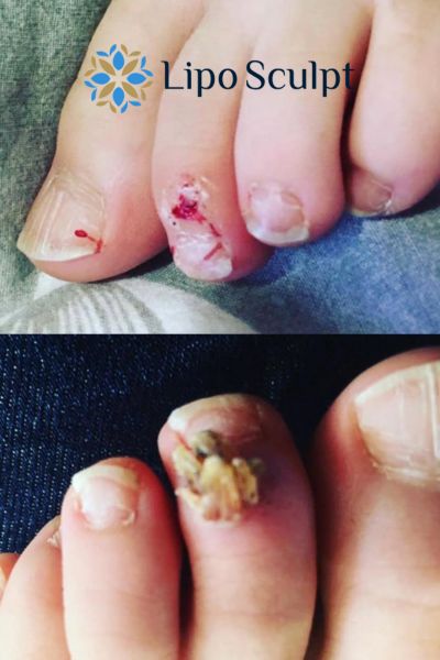 Wart removal customer results from Lipo Sculpt Wraysbury